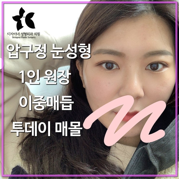  압구정 눈성형 1인 원장 자연스런 이중매듭 투데이매몰 실제 후기