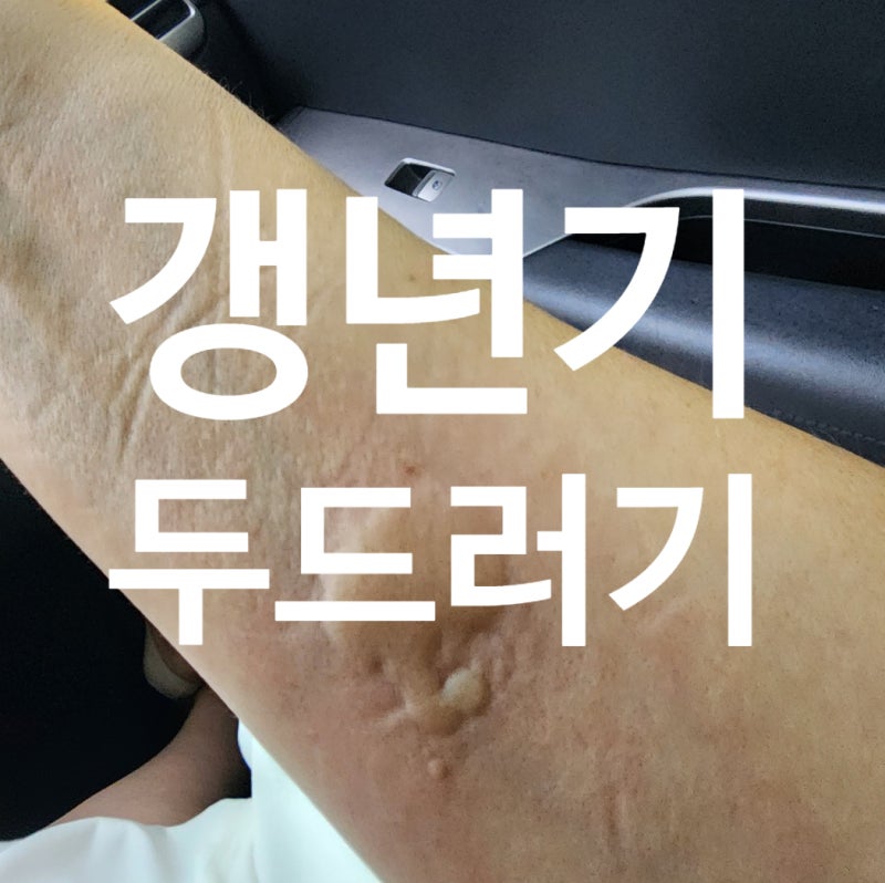 갱년기 두드러기 가려움증 알 수 없는 동행