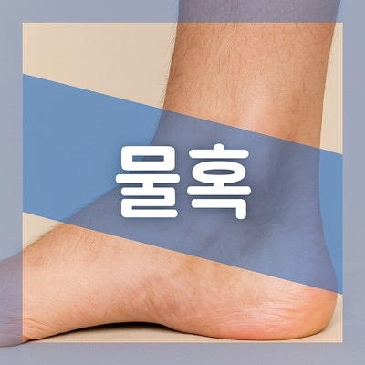 발목 복숭아뼈에 생긴 물혹, 점액낭염 원인과 치료법 알아보기