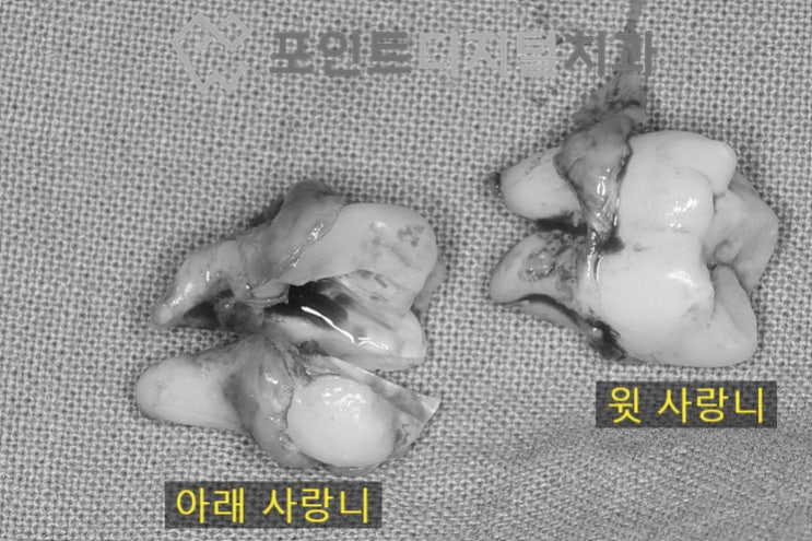  [탕정치과]  매복 사랑니 발치 / 천안 아산 불당 배방