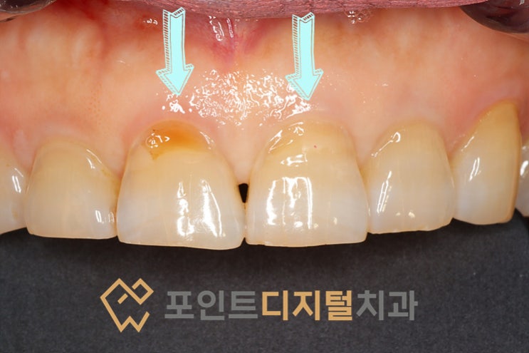  [탕정역치과]  앞니 충전물 탈락부위 레진충전 / 천안 아산