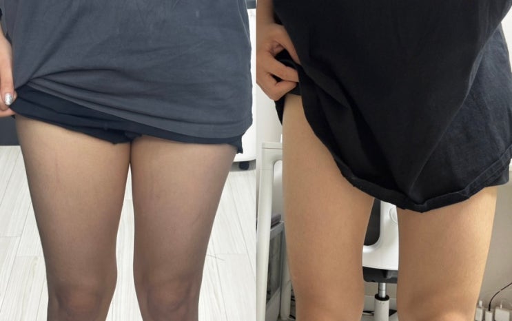  허벅지 살만 유독 많은 체형, 제로팻주사로 집중 공략! 제팻주 1회차 솔직 후기