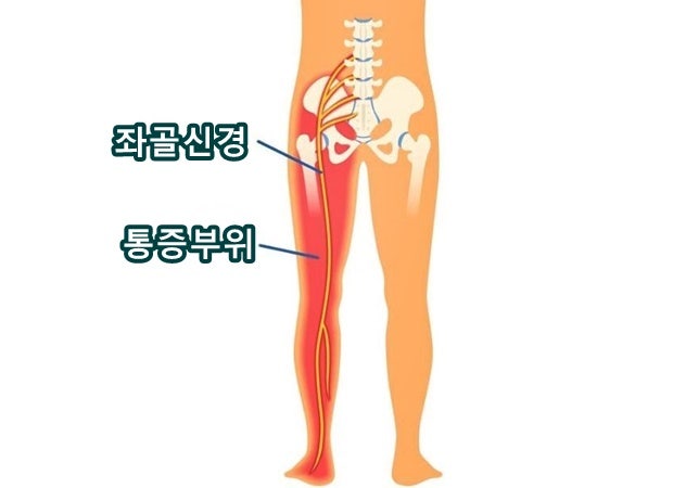 좌골신경통 증상 원인 스트레칭 운동 방석 잠자리 약 주사 치료 병원 한의원