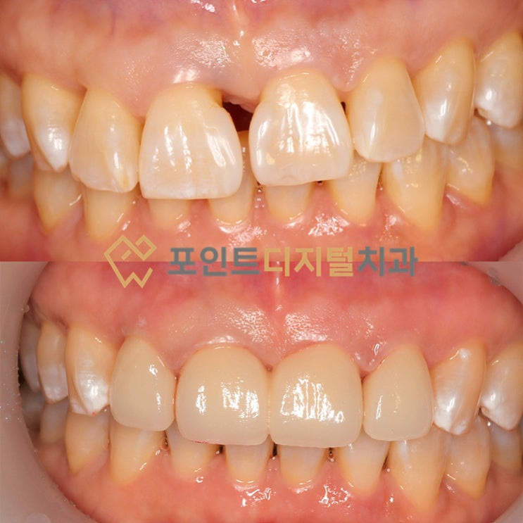  [탕정치과]  앞니가 계속 벌어져요(앞니 공간 → 심미보철로 해결) / 천안 아산