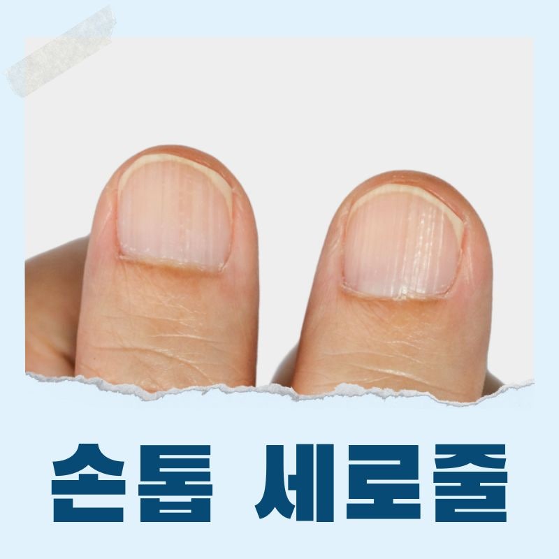손톱검정세로줄 갈색세로줄, 원인부터 대처까지