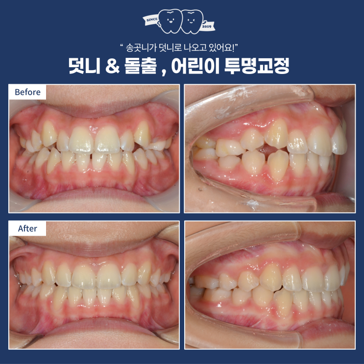  유치가 남아 있는데, 교정이 가능할까요? 덧니에 돌출까지 한 번에 해결하는 투명교정(feat. 인비절라인 퍼스트)
