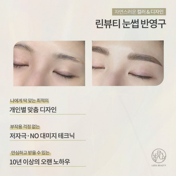  삐땅기 린뷰티에서 헤어라인교정으로 멋진 변화를 경험했어요