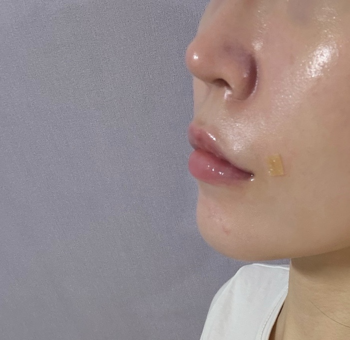  쥬베룩 볼륨 팔자 4cc 내돈내산 후기