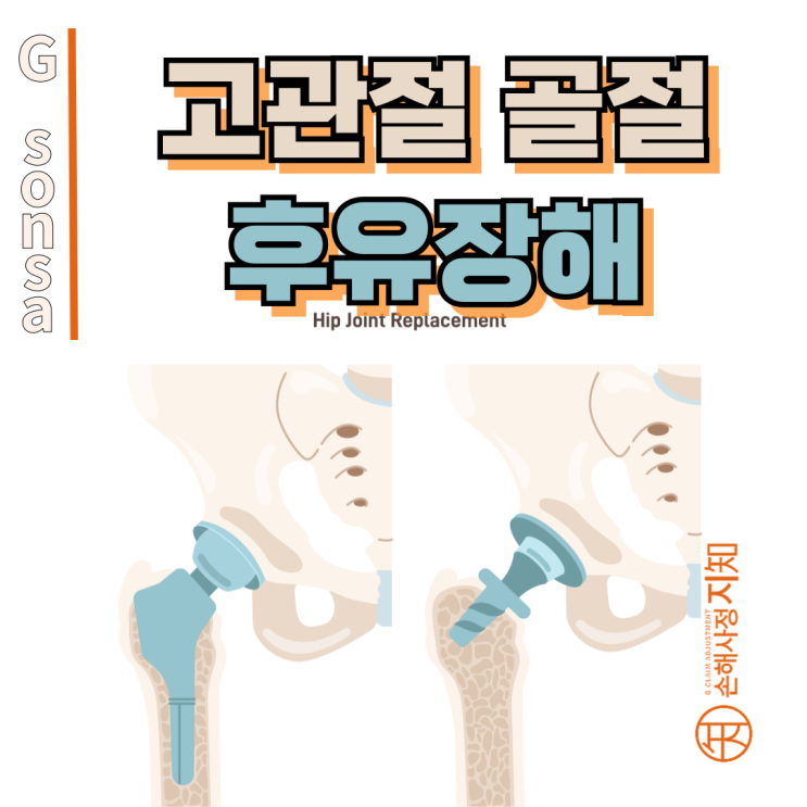  고관절 골절 후유장해, 180일 기다리지 않고 청구하기 - [보험금, BA+DA]