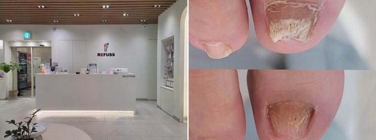  레푸스 천안두정점, 전문적인 내성발톱 관리로 건강한 발을 되찾다