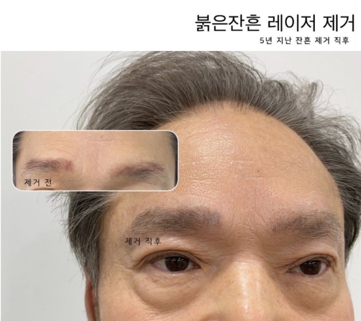  서울눈썹문신제거 후기, 몇 번이면 끝날까?