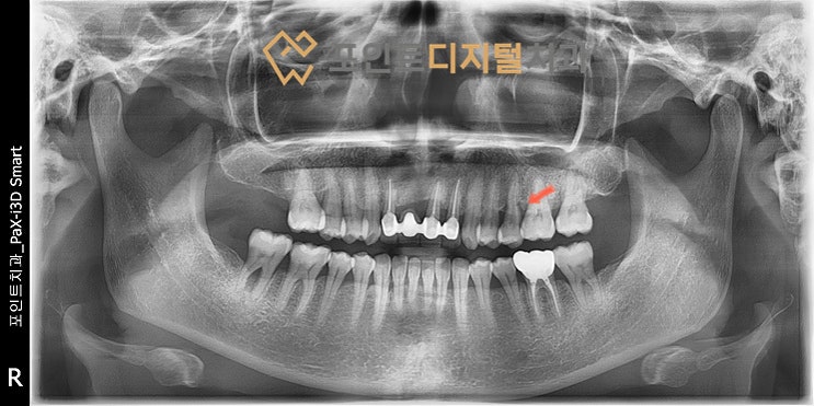  [탕정치과]  치근파절로 발치(발치즉시 임플란트, 덴티움) / 천안 아산