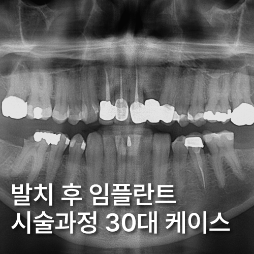  신사역치과 발치후 임플란트 시술과정 30대 남성 케이스