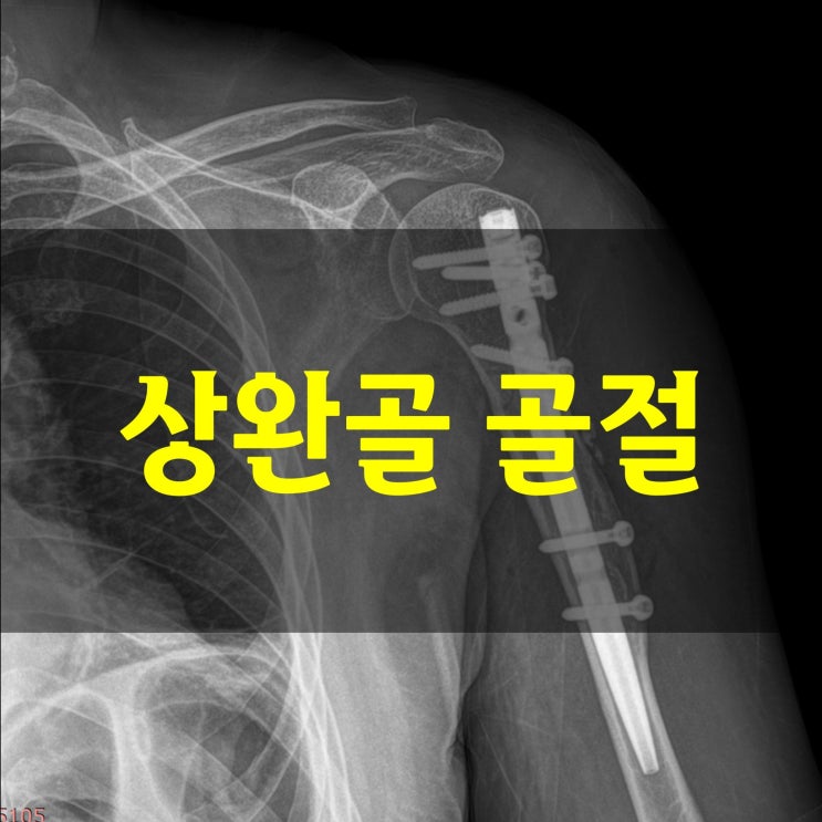  상완골 골절 근위부 간부 원위부 부위별 회복기간
