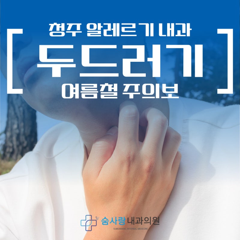 청주 알레르기 내과 여름철 급증하는 급성 만성 두드러기 치료법은?