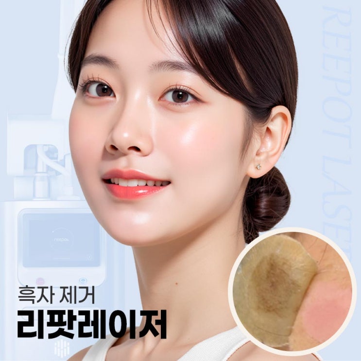  신사동 흑자제거, 색소침착 고민이라면 리팟레이저로