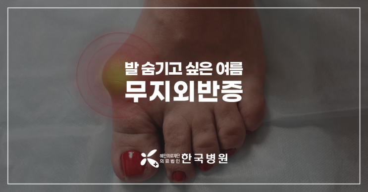  제주 정형외과_발 숨기고 싶은 여름? 무지외반증, 족부 전문의에게