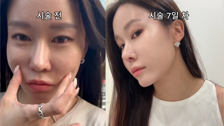  올리디아(Olidia) 시술 후기 – 자연스러운 볼륨과 탄력 회복! 30대 이상이면 꼭 보세요