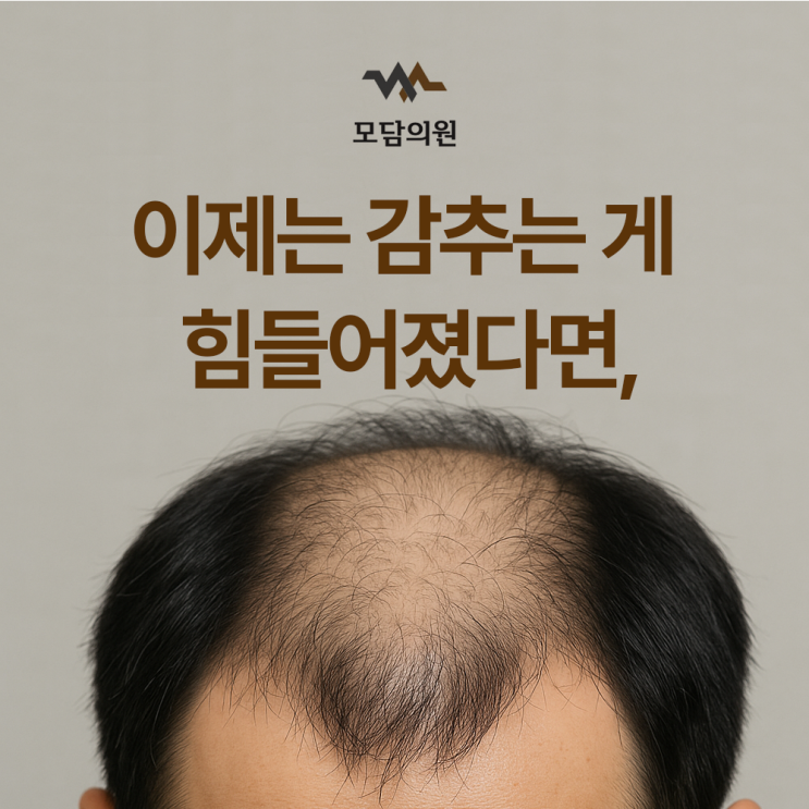  청주모발이식잘하는곳 찾는다면, 20년간 비절개만 고집한 모담의원