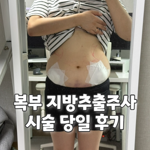  강남 복부 지방추출주사후기 시술당일 통증, 멍과 붓기