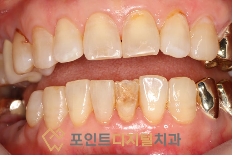  [탕정치과]  앞니 치아파절 크라운으로할까? 레진으로할까? / 천안 아산