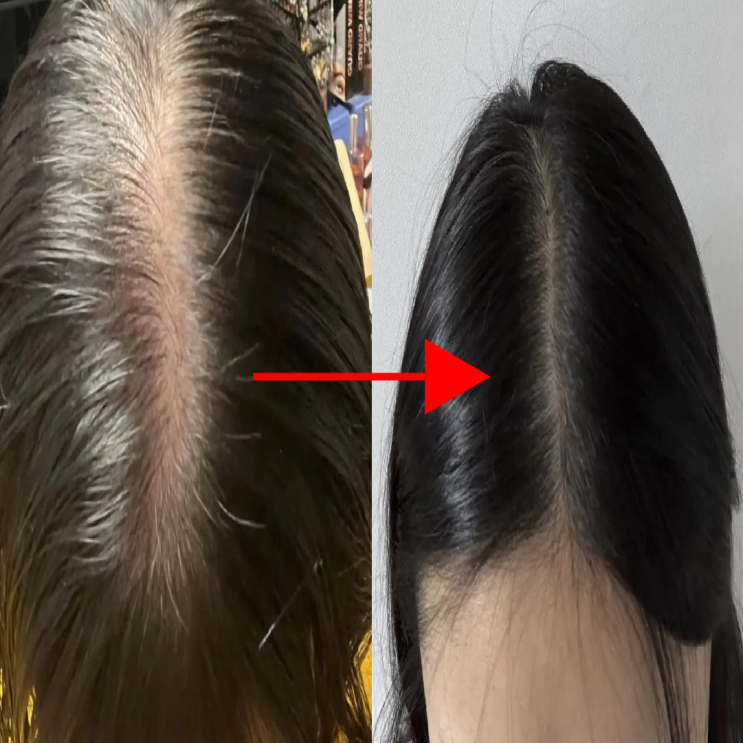  두피 쿨링팩, 정수리 자신감 생김