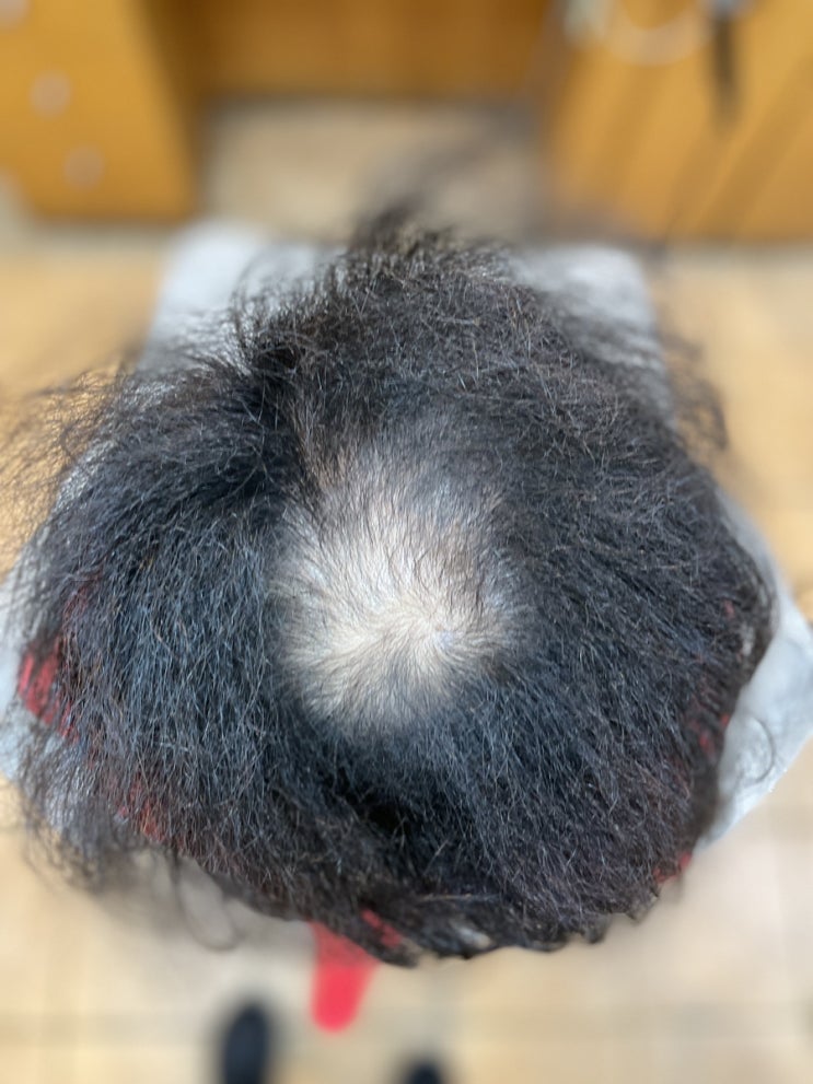  경북에서 남자정수리탈모고객님 단골이되어 매번찾아주셔서 감사합니다 / 부산경남경북남해전라전북충남충북경기강원서울제주