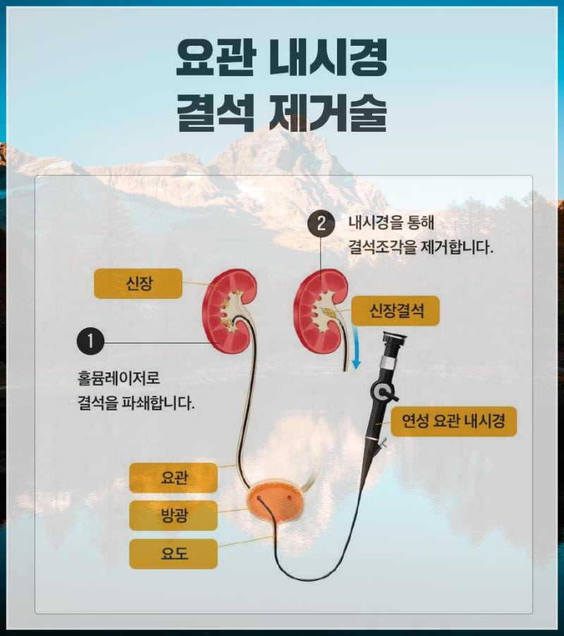 요로결석 파쇄술 후 통증 관리방법과 비용