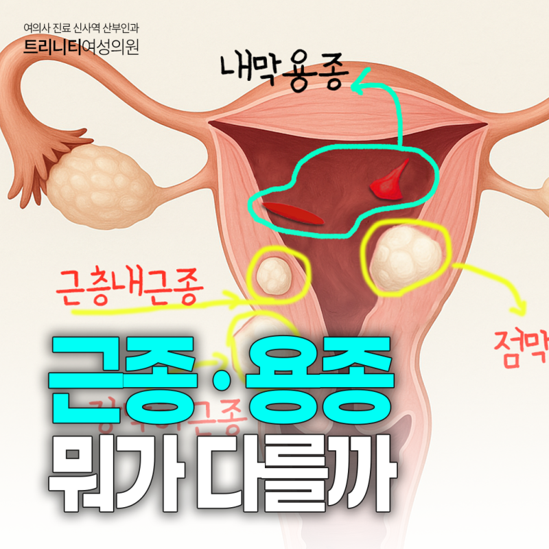 자궁근종 용종 차이를 아시나요?