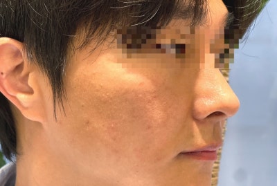 홍대 피부과 리쥬란힐러 통증 완화 후기 1일차~7일차 기록 (남자친구 시술)