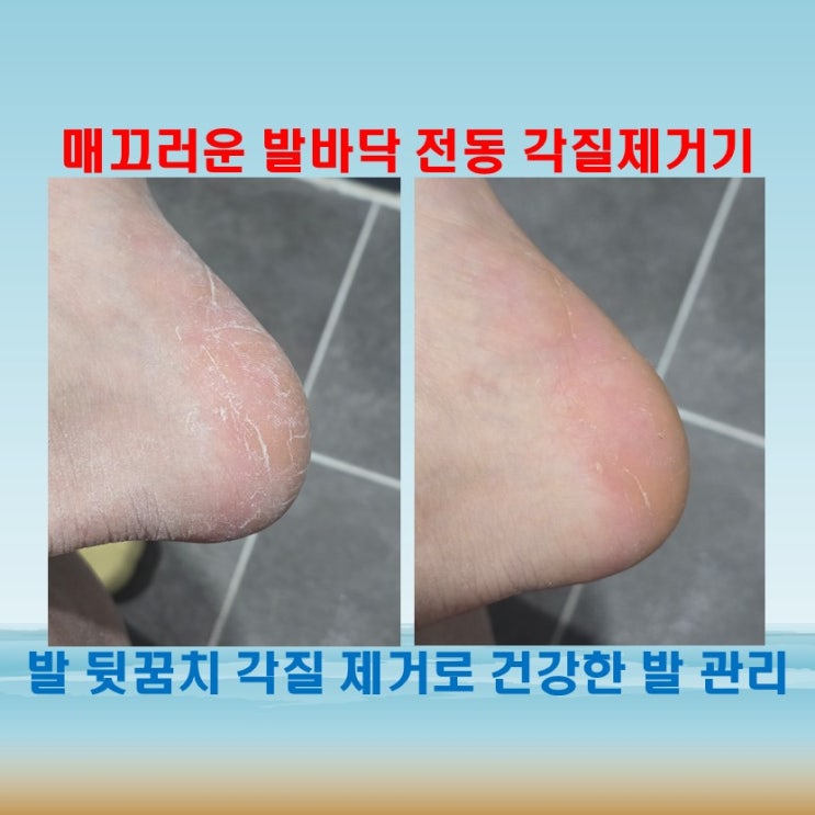  전동 각질제거기 발바닥 각질제거기와 뒷꿈치 각질 관리