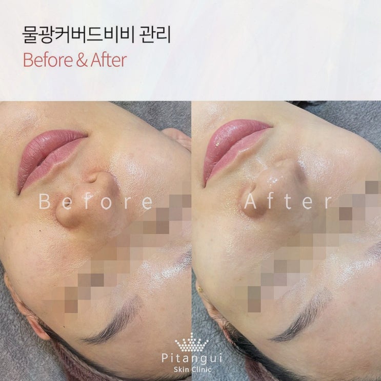  삐땅기린뷰티 센터, 전문적이고 안전한 압구정피부관리