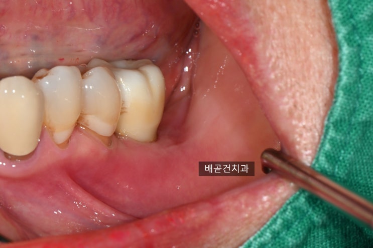  임플란트 후 음식물이 계속 낀다면? 근단변위판막술(APF)+유리치은이식(FGG)으로 해결한 사례 #잇몸이식