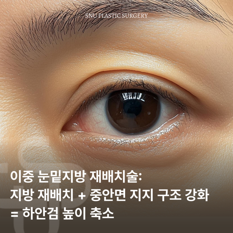  이중 눈밑지방 재배치술에 대해