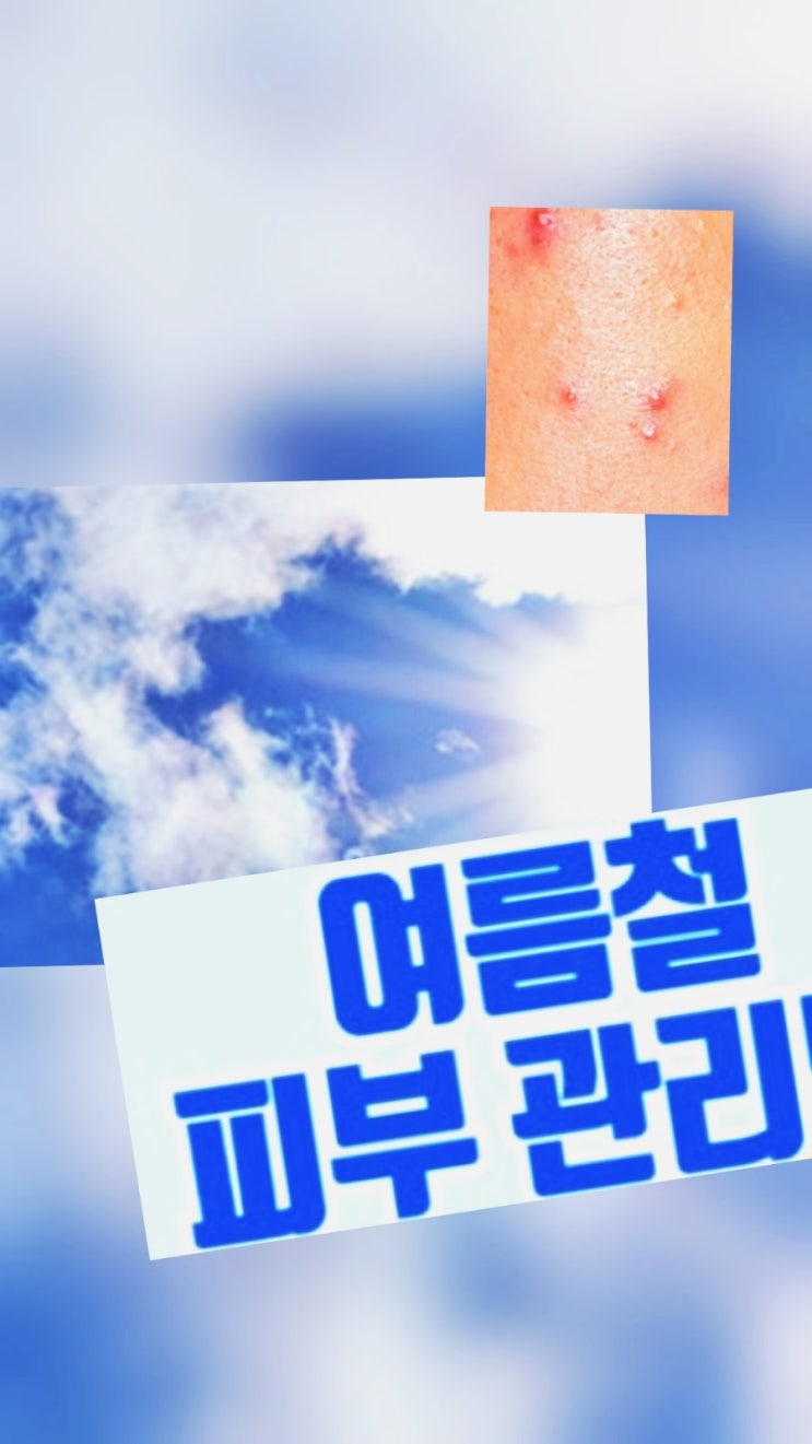  고온다습한 여름 피부 트러블 SOS! 곰팡이균부터 자외선까지 피부 건강 관리리 수칙