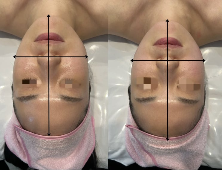  얼굴비대칭 고민이라면? 부산 동래 피부관리윤곽관리비대칭 전후 비교!