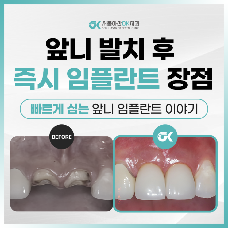  [임상사례] 하남시청역근처치과, 전치부 발치즉시 임플란트로 하루 만에 앞니 회복!