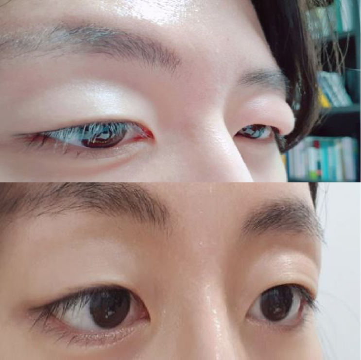 이마 보톡스 눈붓기 해결함