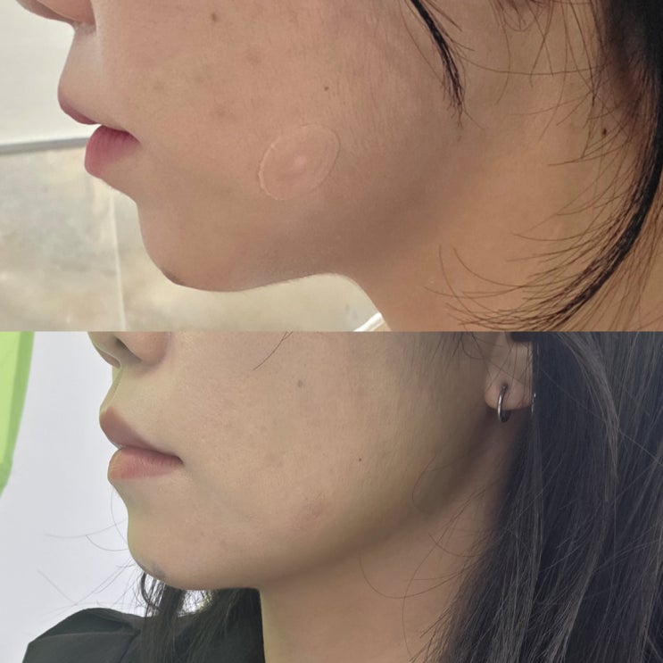  연신내울쎄라100샷 슈링크300샷 연신내피부과 이중턱 효과 솔직후기