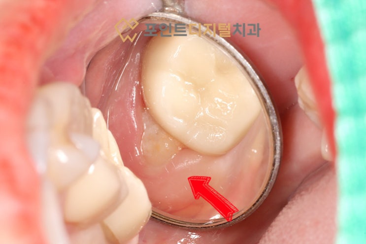  [탕정치과]  매복 사랑니 발치 / 천안 아산