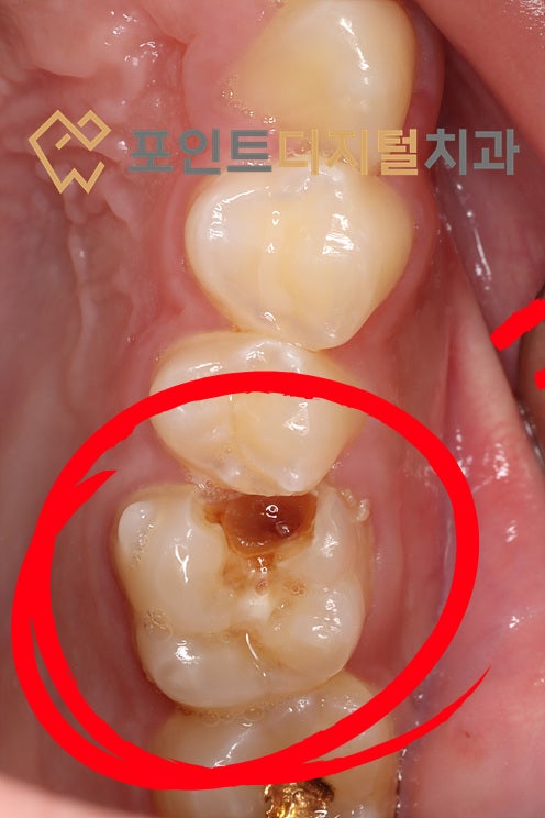  [탕정치과]  이번주 군입대해요(신경치료, 레진충전) / 천안 아산