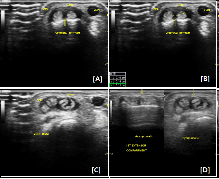 Case Study_939:드퀘르뱅 건초염(De Quervain Tenosynovitis)-초음파영상과 치료에 대한 종합적 접근