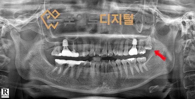  [탕정치과]  매복 사랑니 발치 / 천안 아산