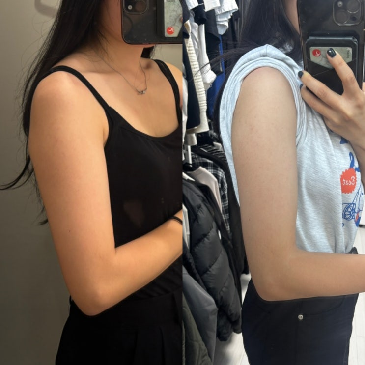  유라인클리닉 지방분해주사 팔뚝컷주사 완주 중! 웨딩사진 찍으러 가기 전 마지막 관리까지