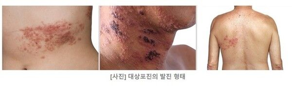  "감기 몸살인줄 알았는데 대상포진"…골든타임은 72시간[몸의경고]