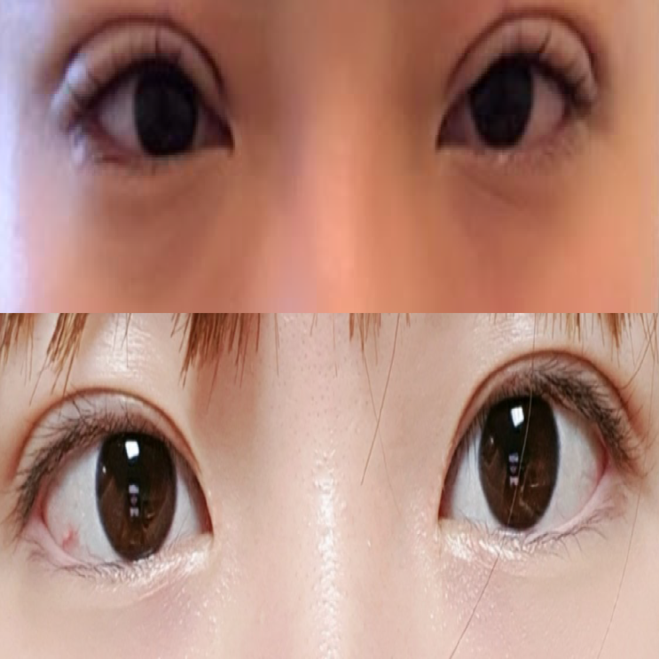  쌍꺼풀 수술 붓기 다해봄