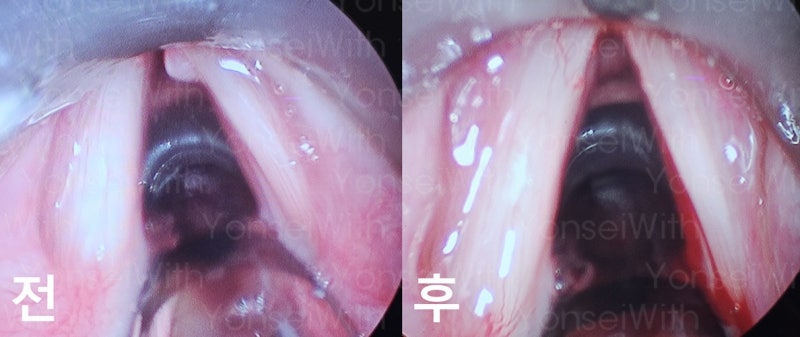[오늘의 수술] [전문의 작성] 성대용종 제거 수술 후기. 전신마취로 진행한 성대 폴립 절제술 ....