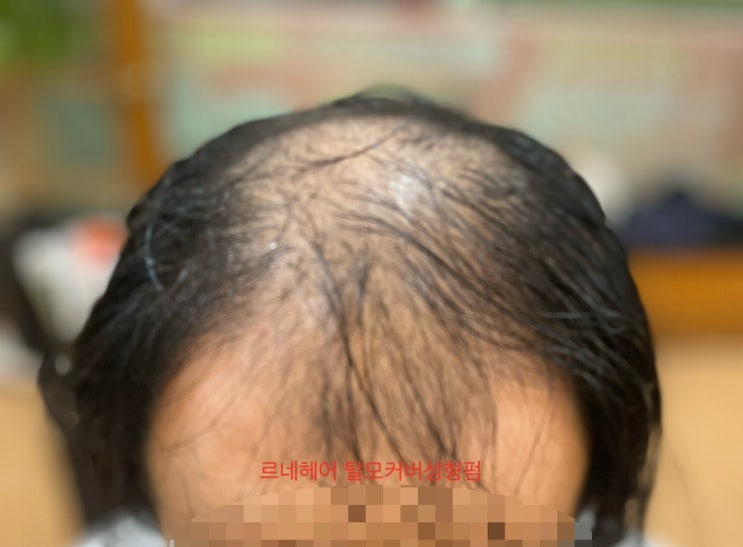  대머리 남자탈모리얼반전이일어난다 부산탈모성지르네시떼사상구미용실/ 사상덕천동구수정화명대저진영명지녹산장유김해에코델타우도좌동해운대대연광안망미수영범일영도진해용원창원진주밀양경주반송
