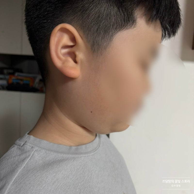 이하선염? 볼거리? 증상부터 전염까지 병원 치료와 약 처방 후기