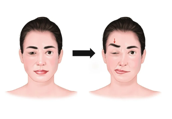  한쪽 눈떨림 원인 , 눈꺼풀 눈위 눈밑 떨림 혹시 반측성 안면경련